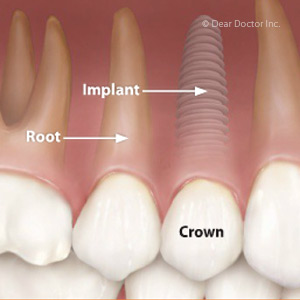 implant.