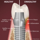 Two Major Causes for Implant Failure and How You Can Prevent Them