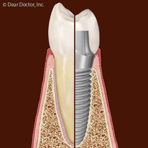 dental implant.