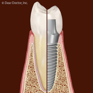 DentalImplantscanalsoSupportOtherTraditionalRestorations