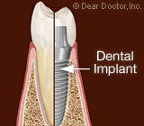 dental implants.