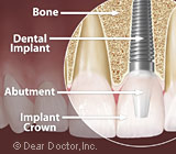 dental implants.