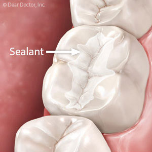 Dental Sealants Give Children an Added Boost Against Tooth Decay
