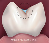 dental-sealants.jpg
