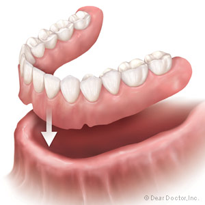 QuizTestYourKnowledgeonDentures