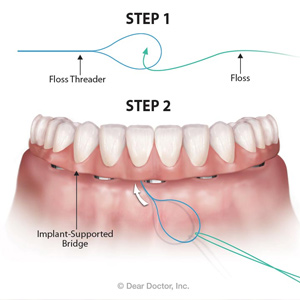FlossingDailyAroundImplantswillHelpPreventLosingYourBridge