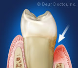 gum disease.