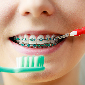 Beat Dental Plaque While Wearing Braces with These Tools and Tips