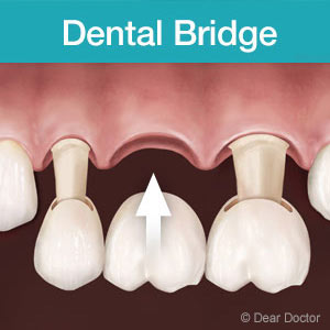 IfYourenotaGoodCandidateforDentalImplantsConsiderBridgework