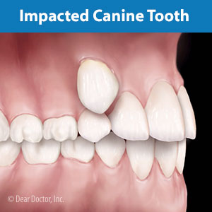 Drawing Impacted Teeth Out of the Gums Could Help Normalize a Smile