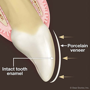 YouMayNotNeedPermanentToothAlterationWithTheseUltra-ThinVeneers