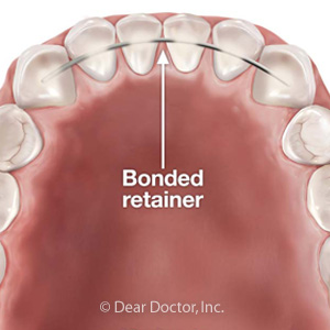 ABondedRetainerMightbeaBetterChoiceAfterBraces