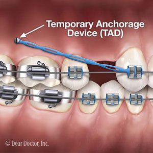 Anchorage Tools Help Orthodontists Correct Complex Bite Problems