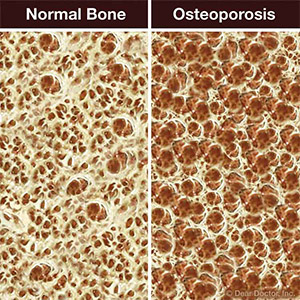 OsteoporosisCanCauseComplicationsForSomeTypesofDentalWork