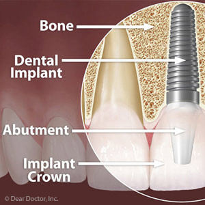 immediate implant.