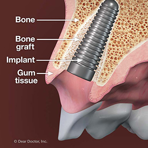 YourGumsandBoneNeedtoBeHealthyBeforeGettingImplants