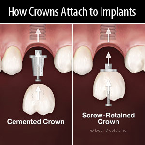 How Is a Crown Attached to a Dental Implant?