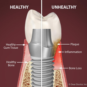 Gum Disease is Still a Threat to Your Dental Implants - Haslet ...