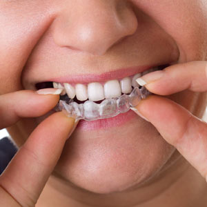 An Orthodontic Retainer: Insurance Well Spent for Keeping Your New Smile
