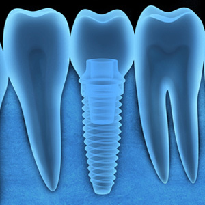 CouldYourMetalAllergyKeepYouFromObtainingDentalImplants