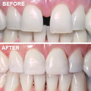 Orthodontic Teeth Movement Toronto CA