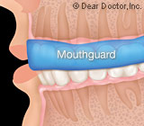 Mouthguards.