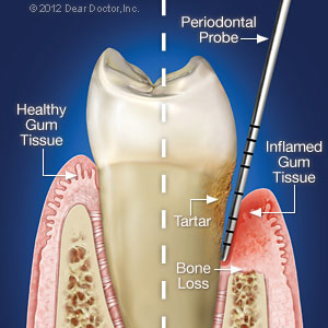 perio disease.