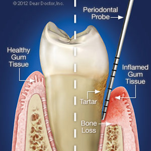 Periodontal Probing Increases Accuracy in Diagnosing Gum Disease