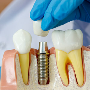 DentalImplantsCouldHelpPreserveBoneAfterToothLoss