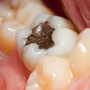 HerearetheFactsontheImpactofMetalAllergiesonDentalWork