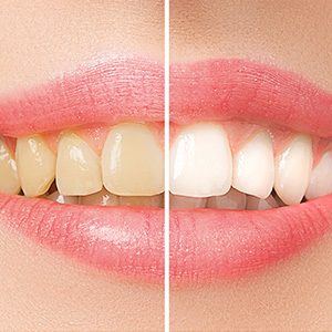 teeth whitening