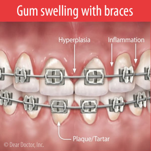 Braces while swollen gums wearing What Swollen