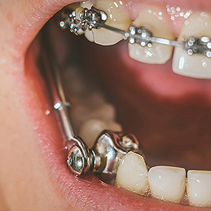 ThisOrthodonticDeviceCouldStopaPoorBiteFromDeveloping