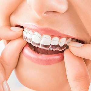 Good Reasons for Choosing Clear Aligners for Orthodontic Treatment ...