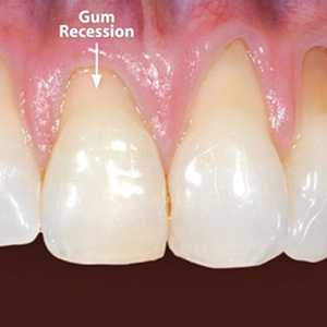 4 Things You Can Do to Avoid Damage From Gum Recession