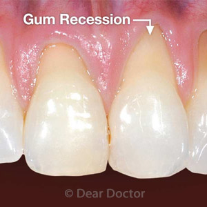 GumRecessionCouldHaveLong-RangeConsequencesForYourDentalHealth