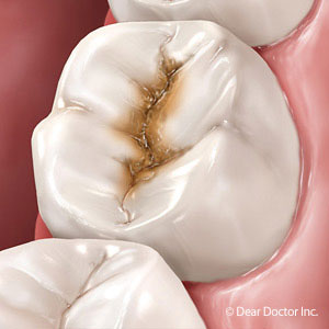 Manage These Risk Factors to Reduce Your Risk of Tooth Decay