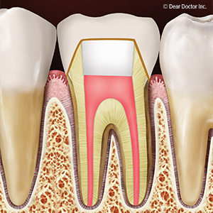 How a Root Canal Can Save your Tooth