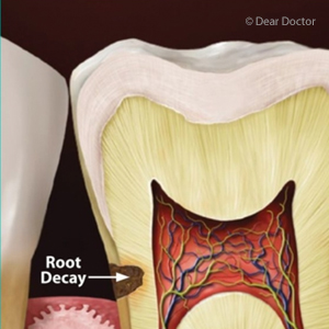 If You’re Older, be on the Lookout for Root Cavities
