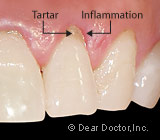 RootPlaningRemovesDangerousPlaqueandTartarYourToothBrushCant