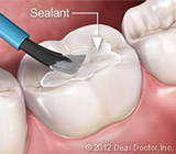 dental sealant.