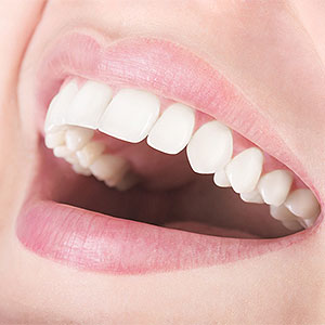 Porcelain Veneers Might not be the Best Option for Teenagers