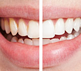 teeth-whitening6.jpg