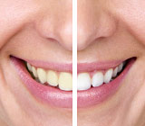 teeth-whitening9.jpg