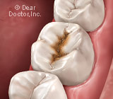 tooth that needs root canal