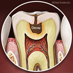 StoppingToothDecayCouldRequireRootCanalTreatment