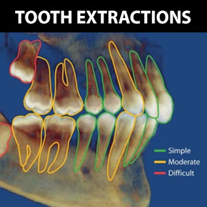 Extracting a Tooth is a Routine Procedure