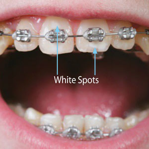 White Spots On Your Teeth After Braces May Be An Early Sign Of Enamel Loss The Brace Place Orthodontics