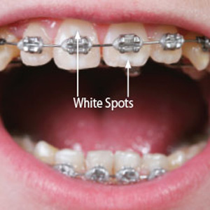 Stop White Spots Before They Appear While Wearing Braces