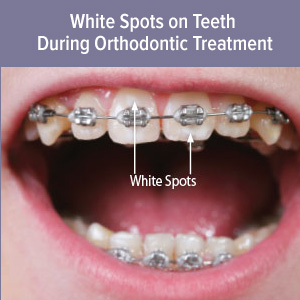 What To Do About White Spots on Teeth After Wearing Braces